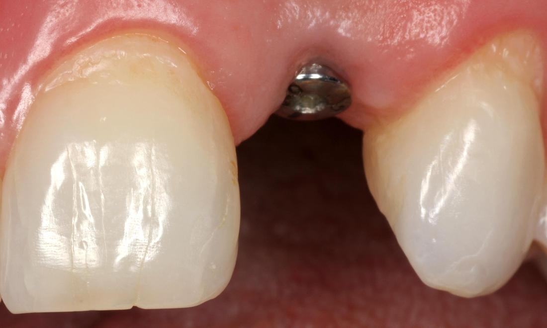 Dental Implant Front Tooth