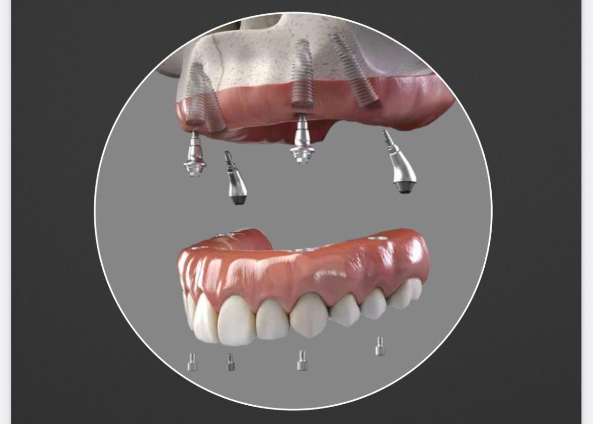 Dental Implants Cost Fort Lauderdale Dental Implants Cost Fort Lauderdale