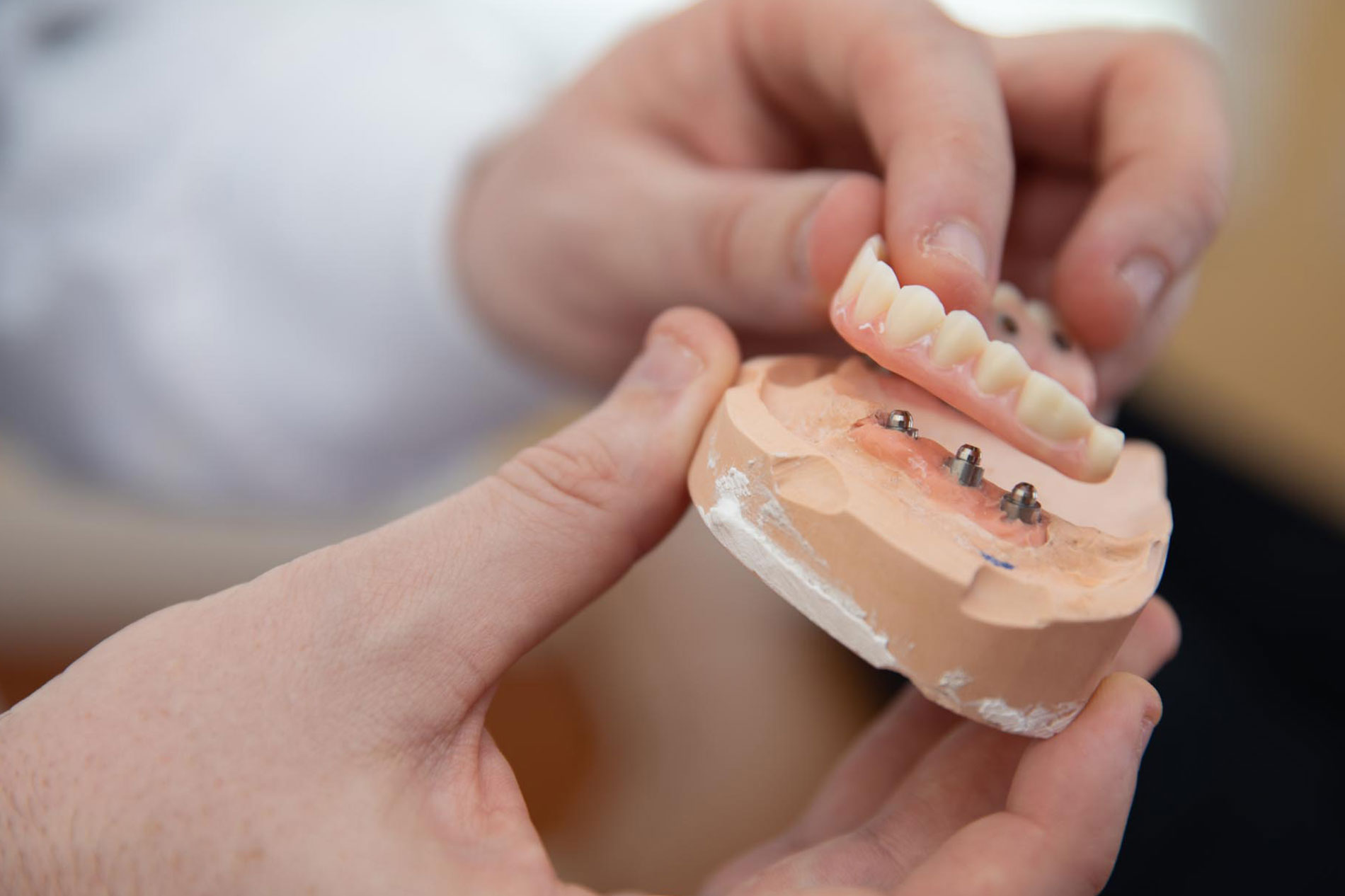 Dental Implants Full Arch: Restoration Simplified