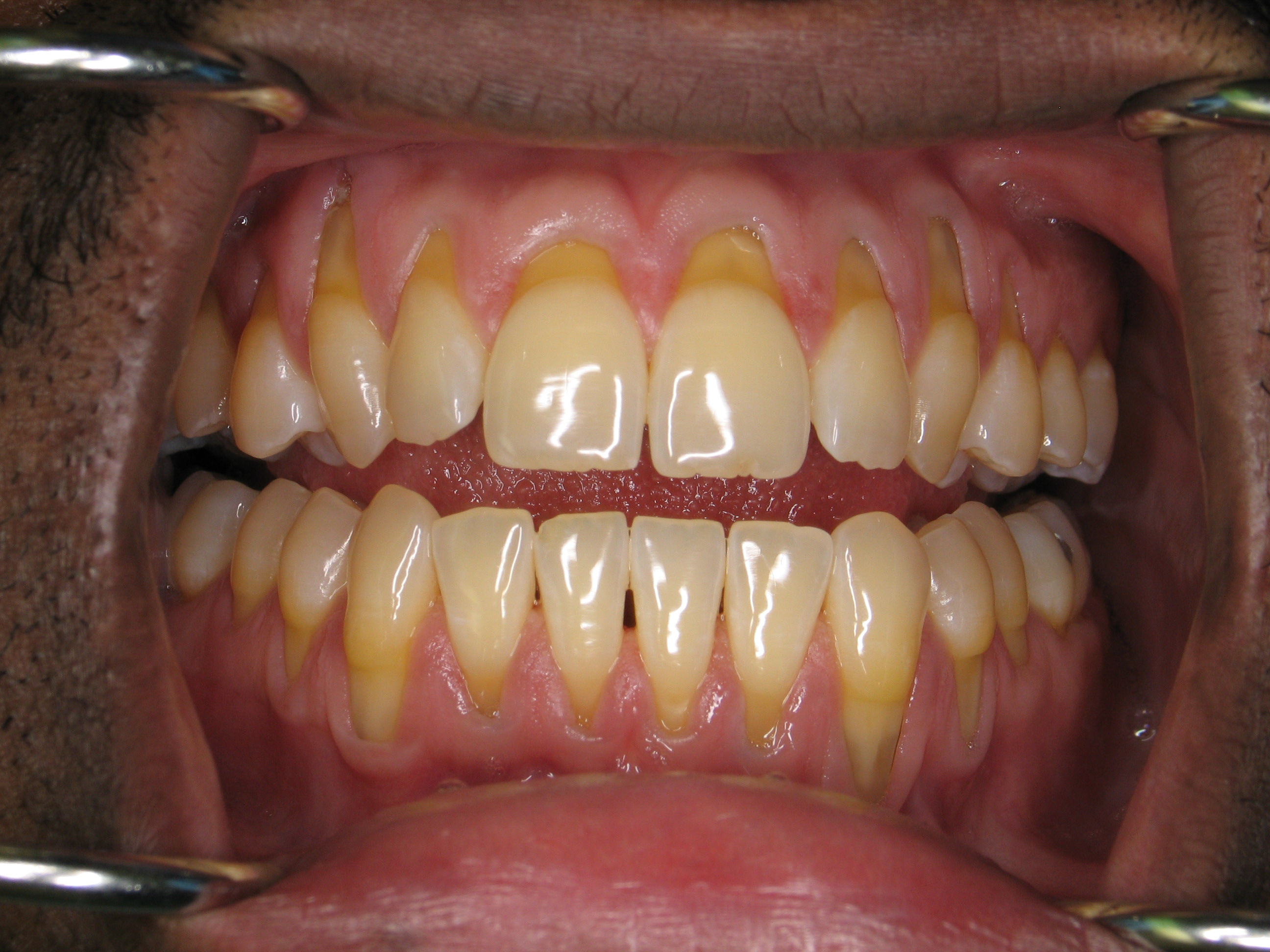Dental Root Exposure