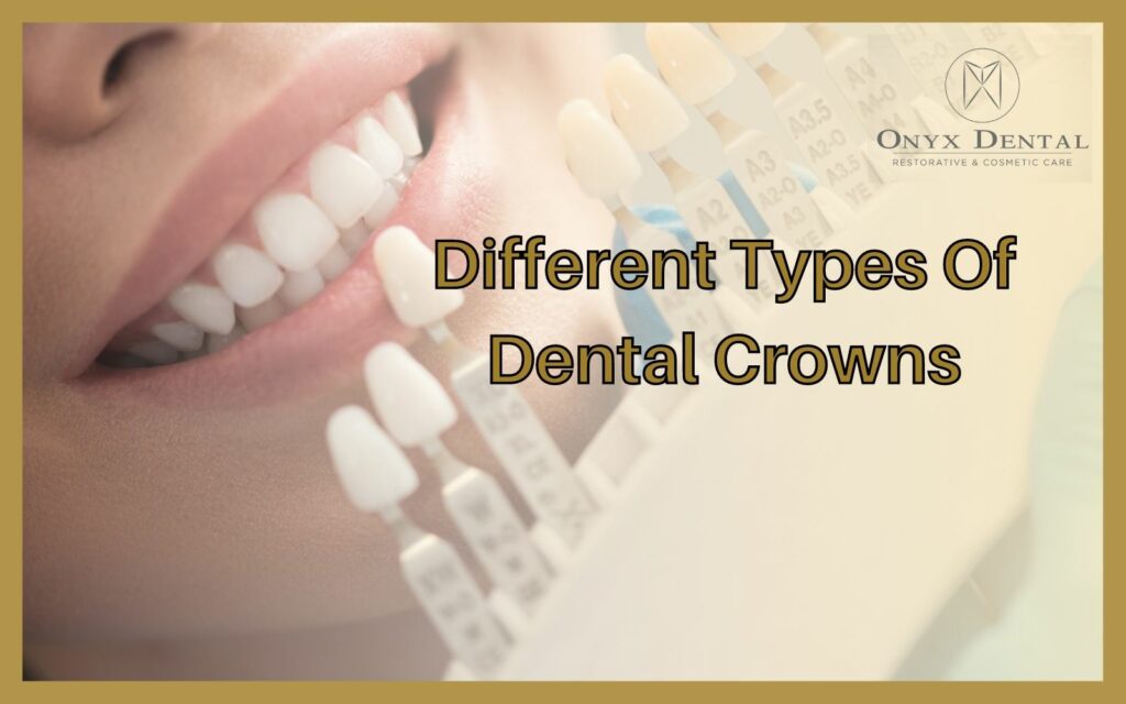 Different Types Of Crowns