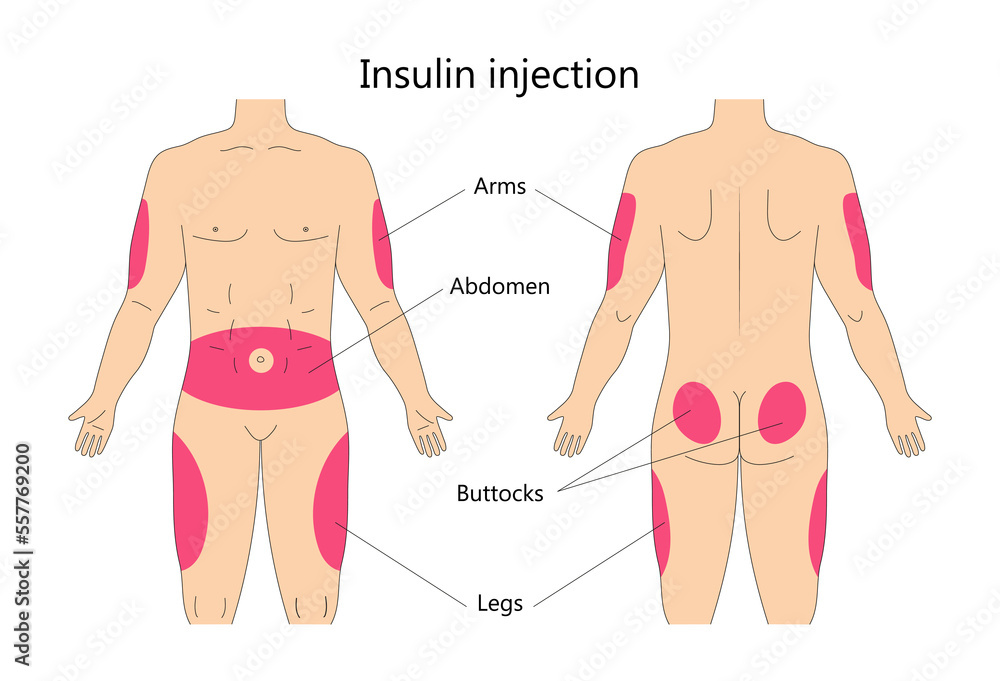 Do Insulin Shots Hurt