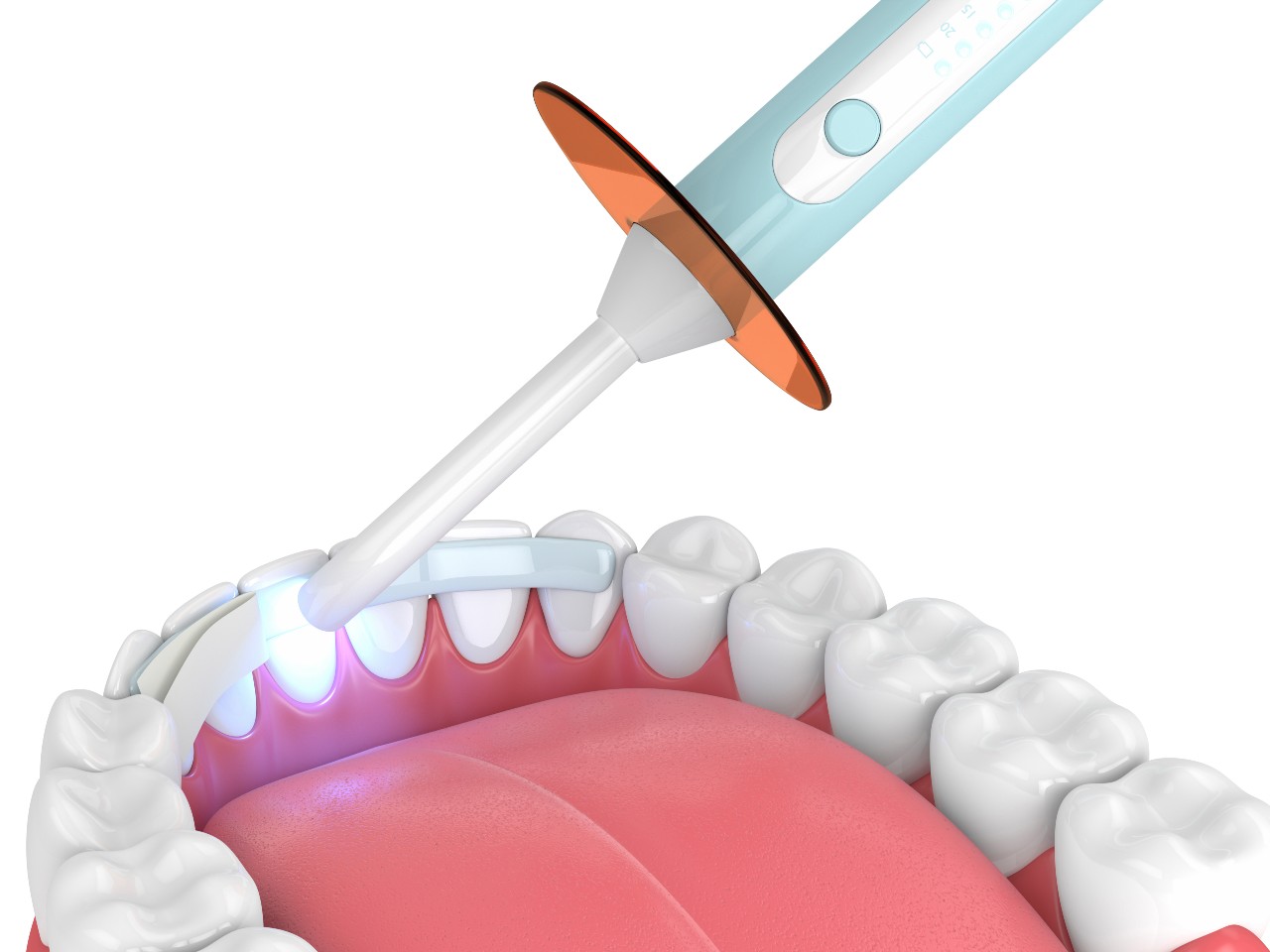 Does Dental Bonding Last