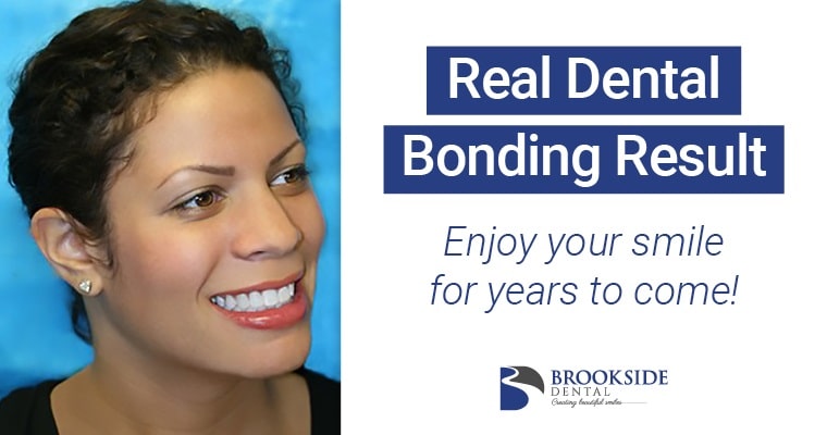 Does Tooth Bonding Last