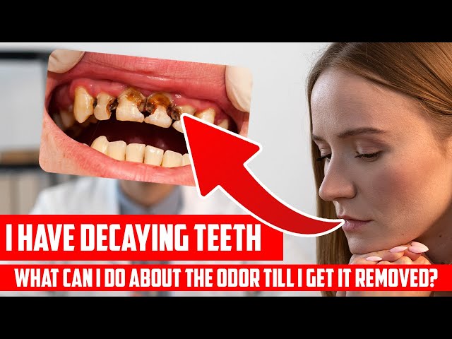 Does Tooth Decay Smell