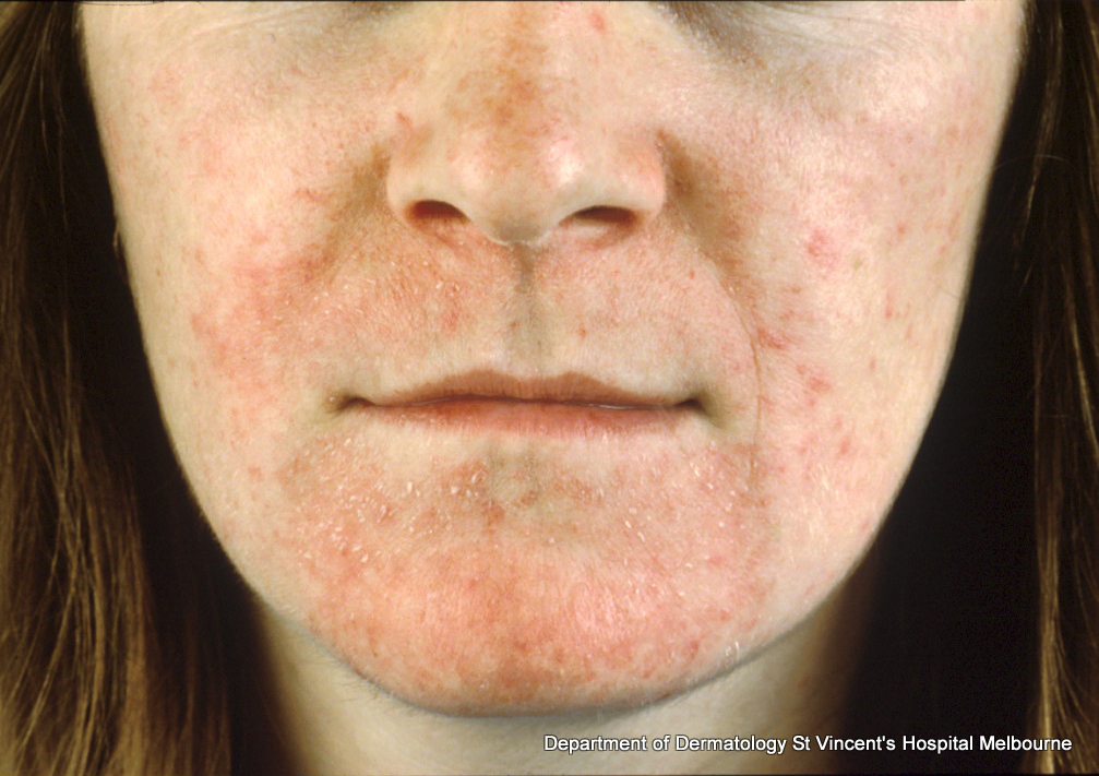 Doxycycline For Dermatitis
