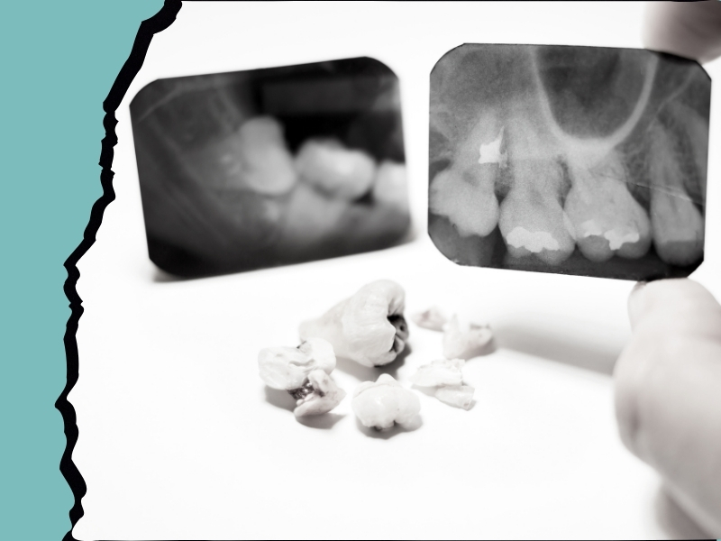 Emergency Molar Extraction