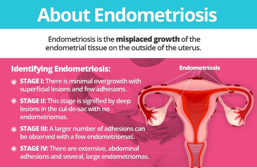 Endometriosis Worse After Pregnancy Endometriosis Worse After Pregnancy