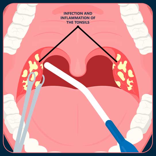 Enlarged Uvula After Tonsillectomy