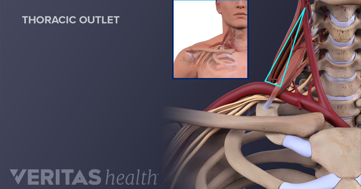 Exercise For Thoracic Outlet: Relieve Pain Naturally