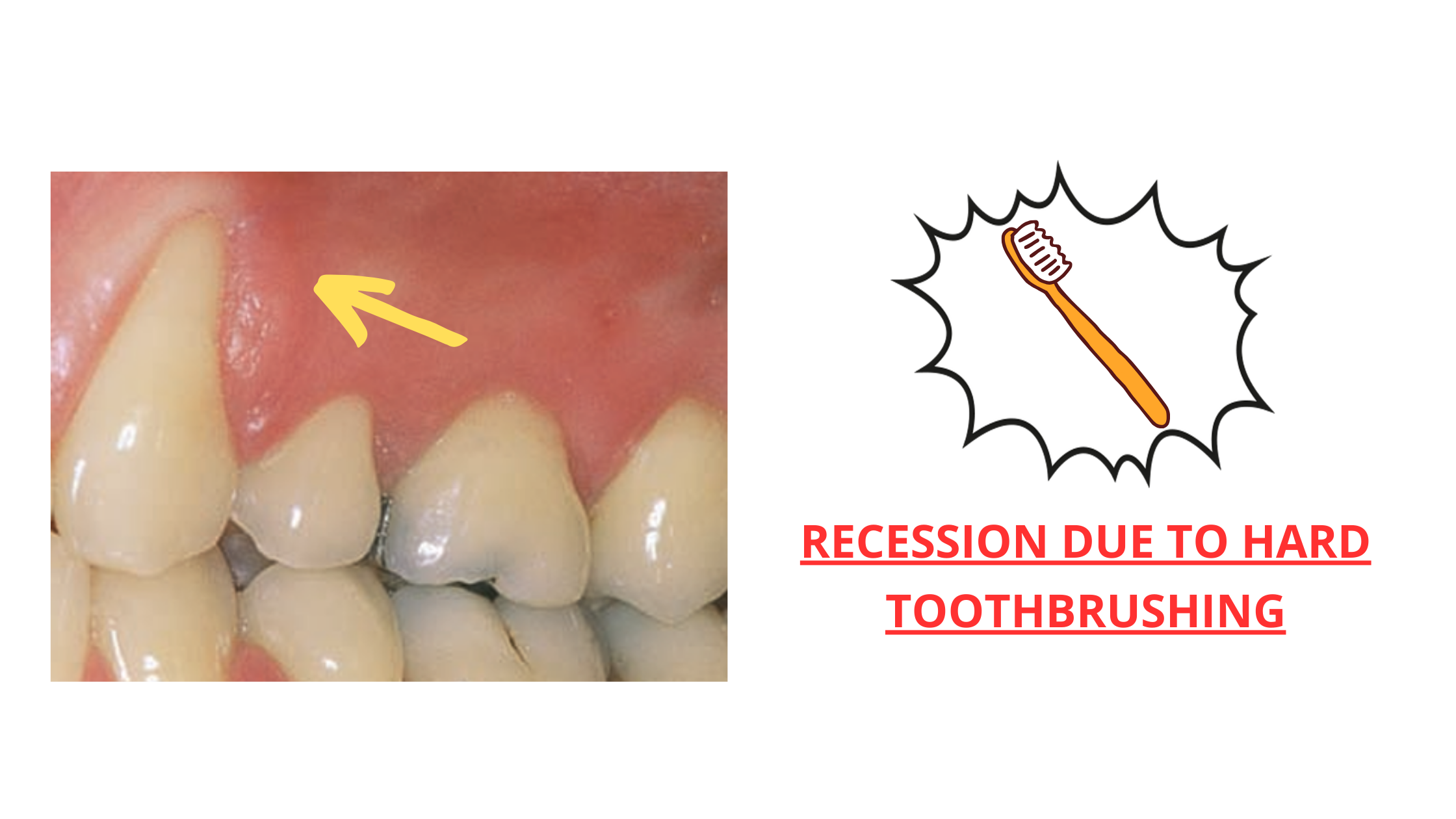 Exposed Tooth Nerve: Find Relief Now Exposed Tooth Nerve: Find Relief Now