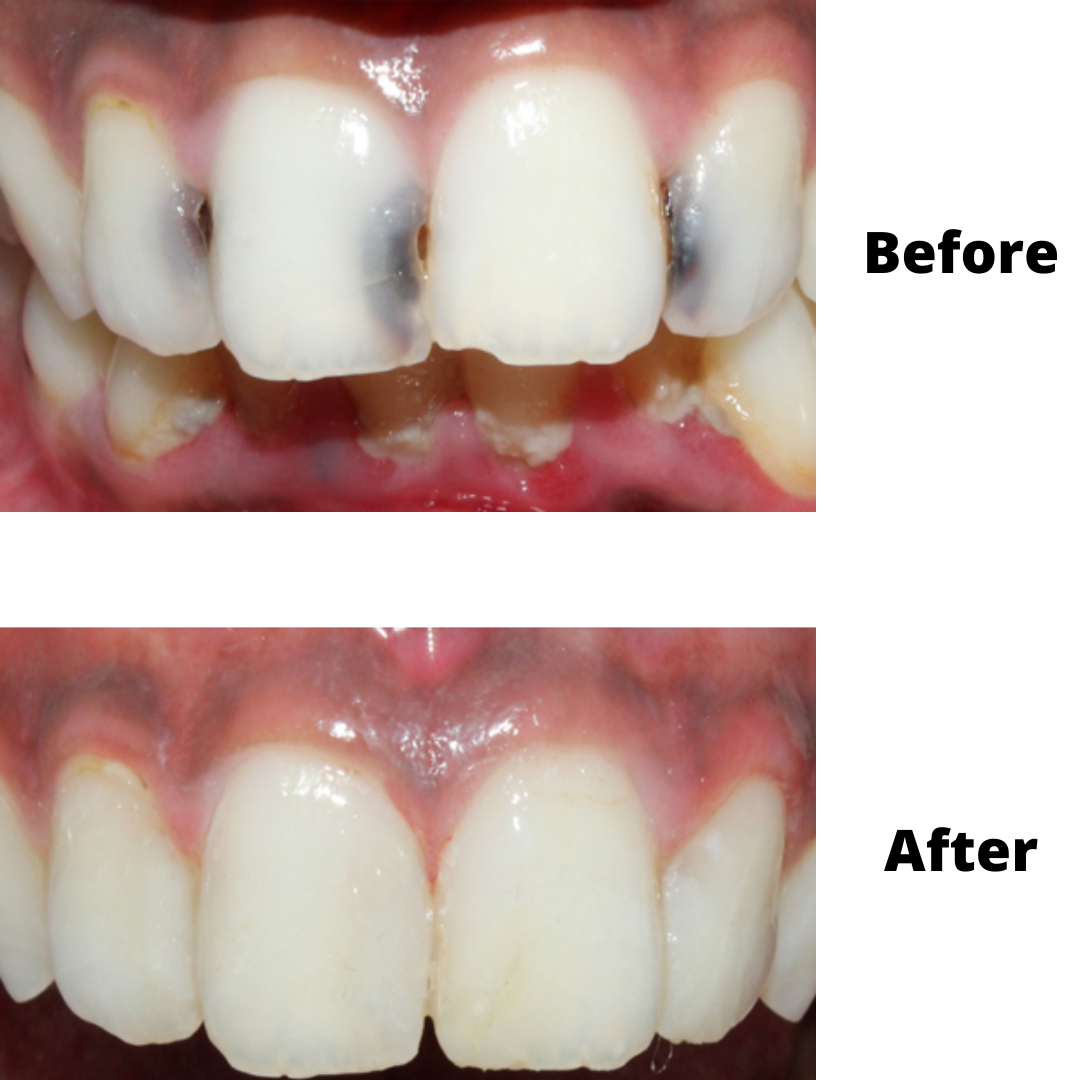 Fillings Between Teeth
