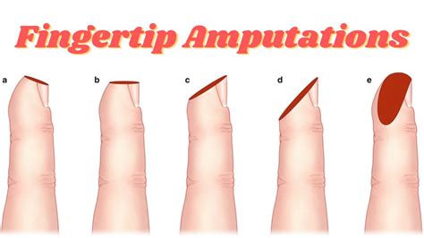 Fingertip Amputation Healing