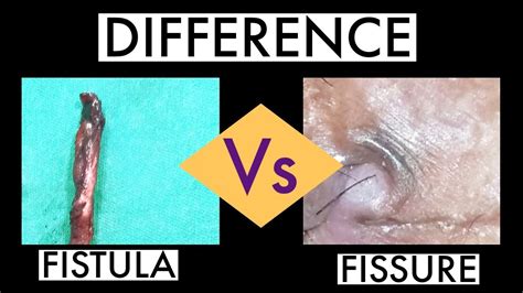 Fissure Vs Fistula