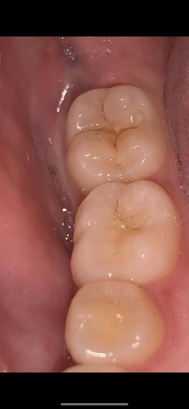 Food Stuck In Cavity Hole