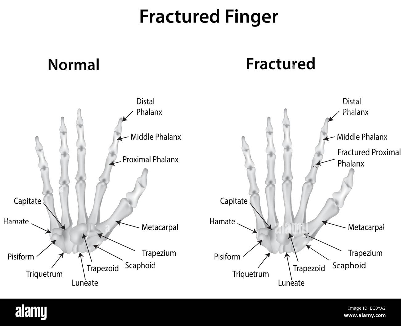 Fractured Little Finger: Recover Fast With Proper Care