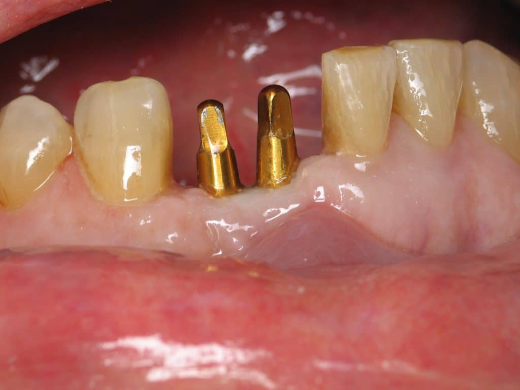 Front Teeth Dental Implants