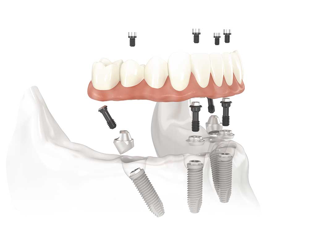 Full Arch Implants: Permanent Smile Solution Found