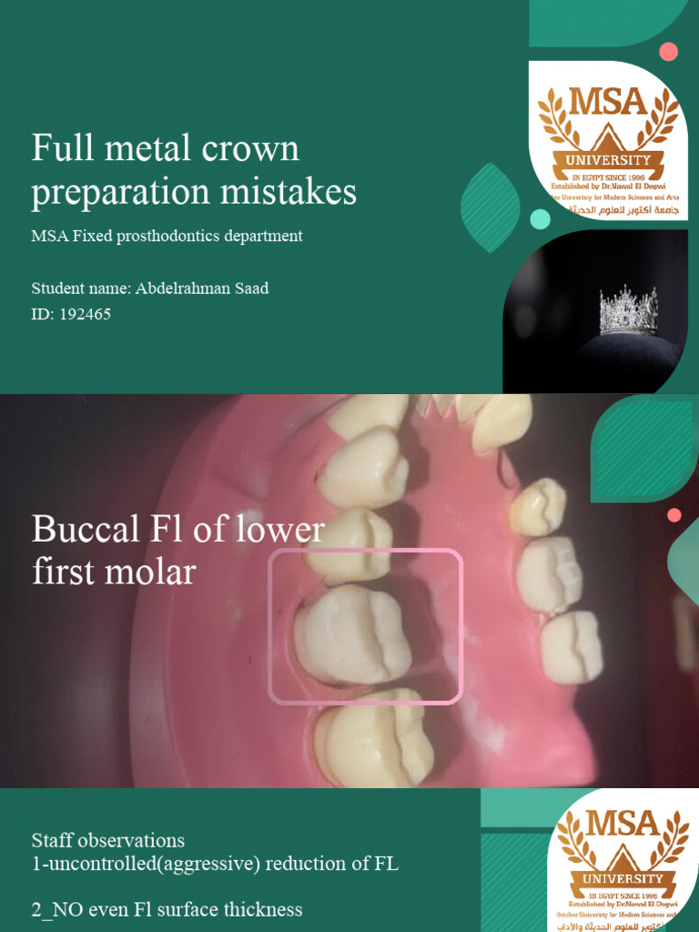 Full Metal Crown Preparation Full Metal Crown Preparation