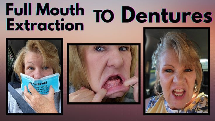 Full Mouth Extraction Healing Time