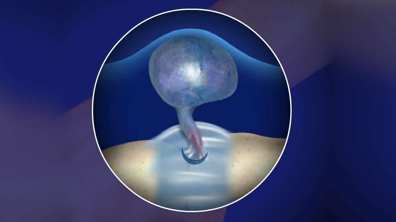 Ganglion Cyst Removal Guide