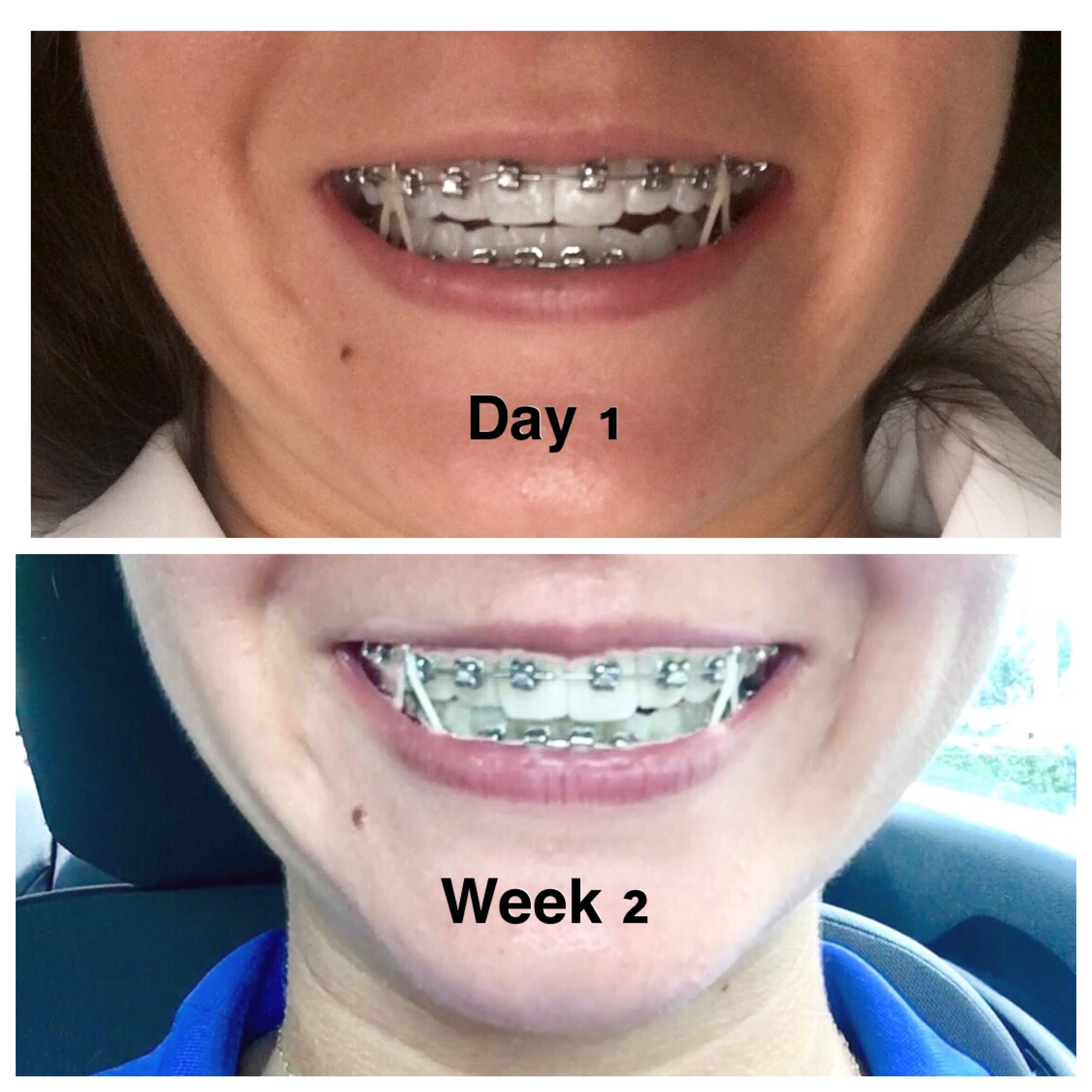 Getting Braces As An Adult