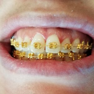 Gold Dental Braces