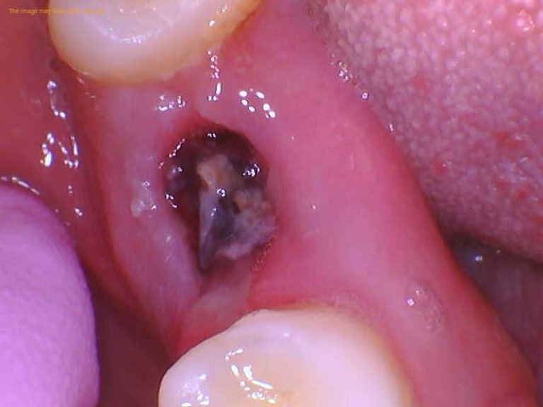 Granulation Tissue Wisdom Tooth: Heal Faster Naturally