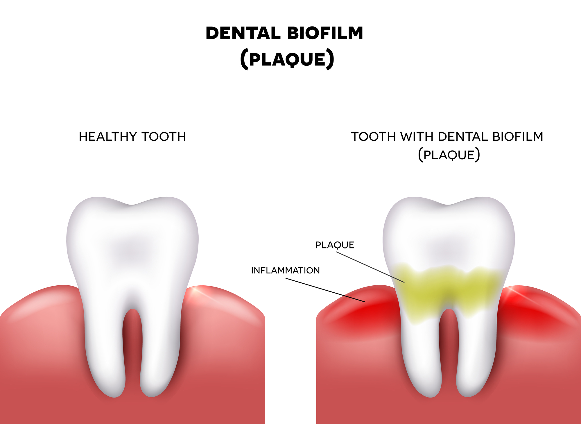 Green Plaque On Teeth