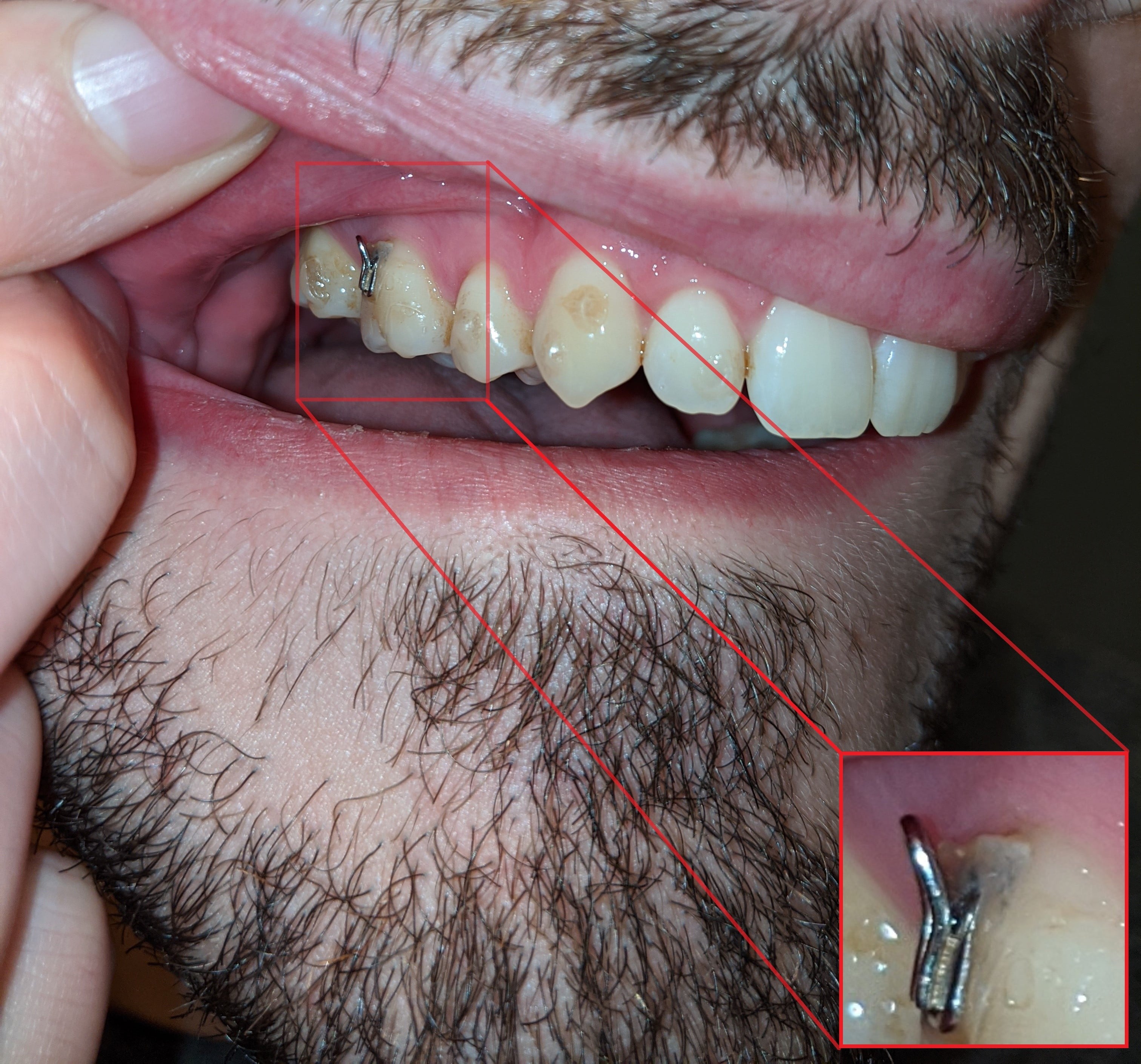 Grey Spot On Tooth