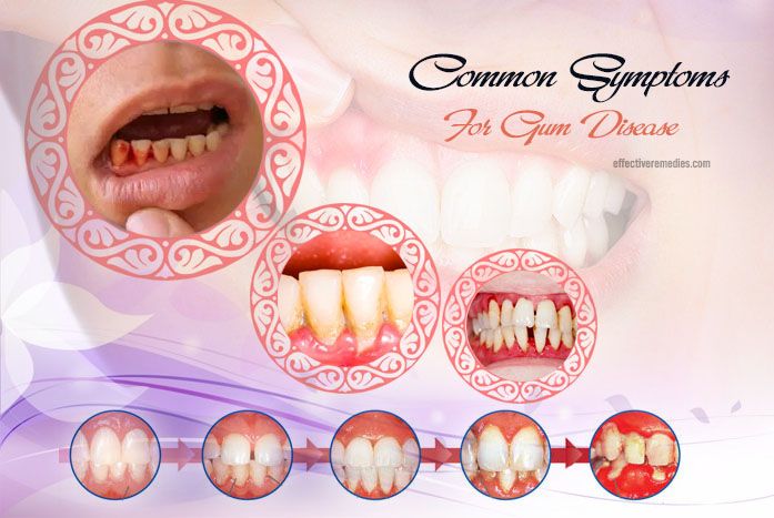 Gum Cut Healing: Natural Remedies Inside