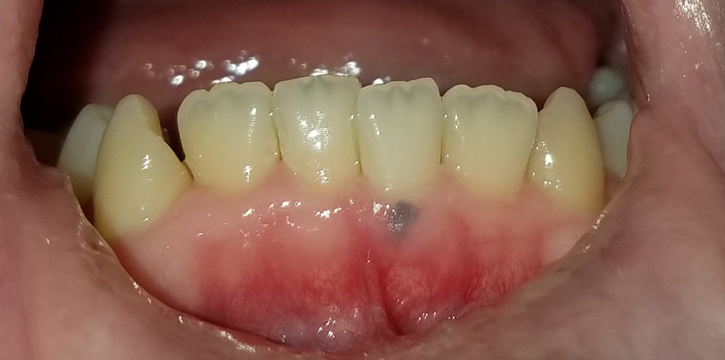 Gum Dark Spot