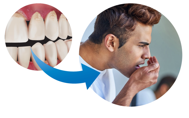 Gum Disease Halitosis