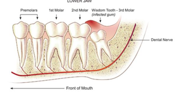 Gum Grew Over Tooth