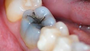 Gum Infection After Root Canal
