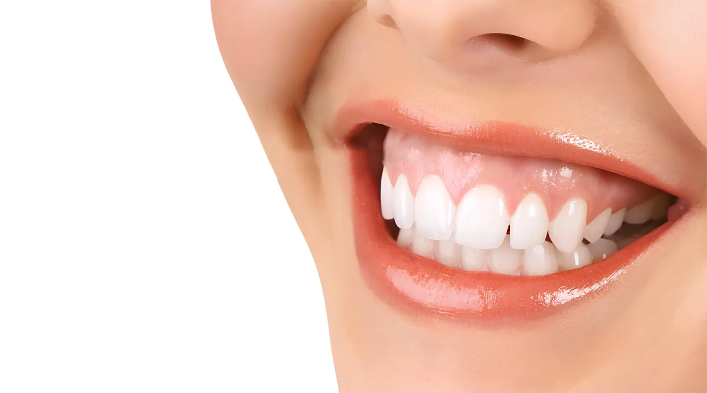 Gum Reduction Surgery