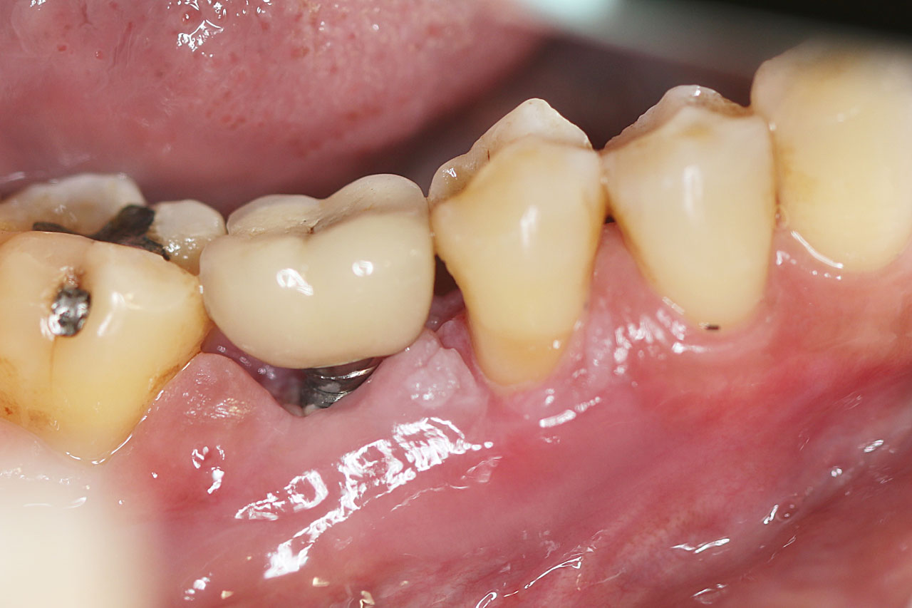 Gums Are White Around Teeth