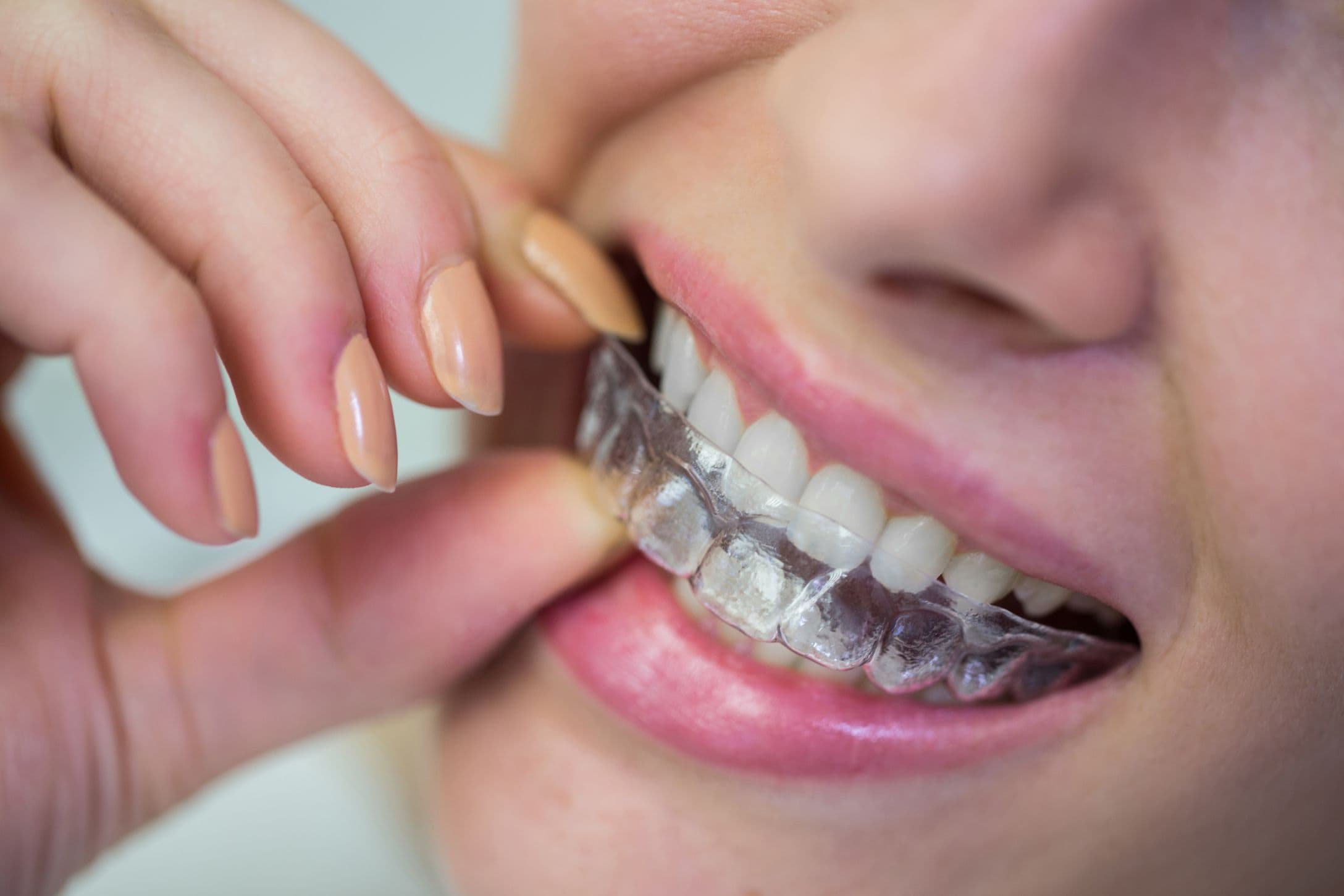 Hawley Retainer On Teeth