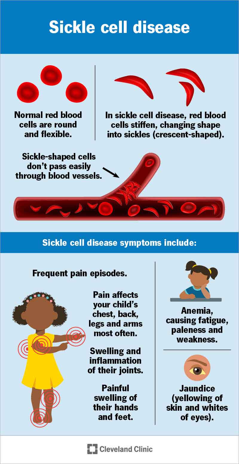 Hemolysis Associated Hypercoagulability In Sickle Cell Disease The Hemolysis Associated Hypercoagulability In Sickle Cell Disease The