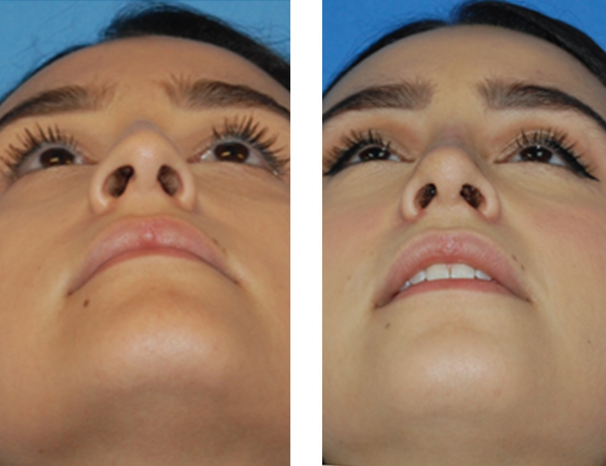 Hole In My Nostril