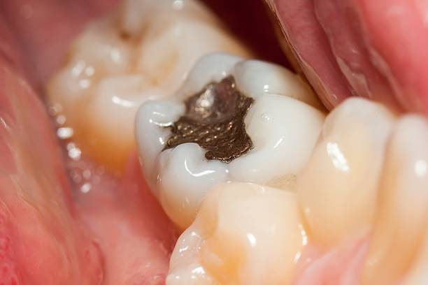 How Bad Do Fillings Hurt? Quick Relief Tips