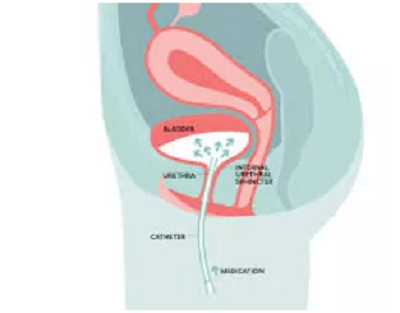 How Does Bladder Instillation Work? Relief Tips