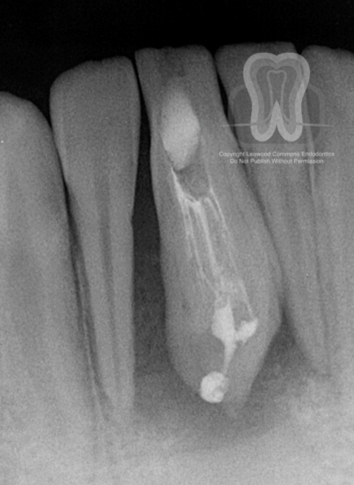 How Is Dens In Dente Treated? X Ray Analysis Help
