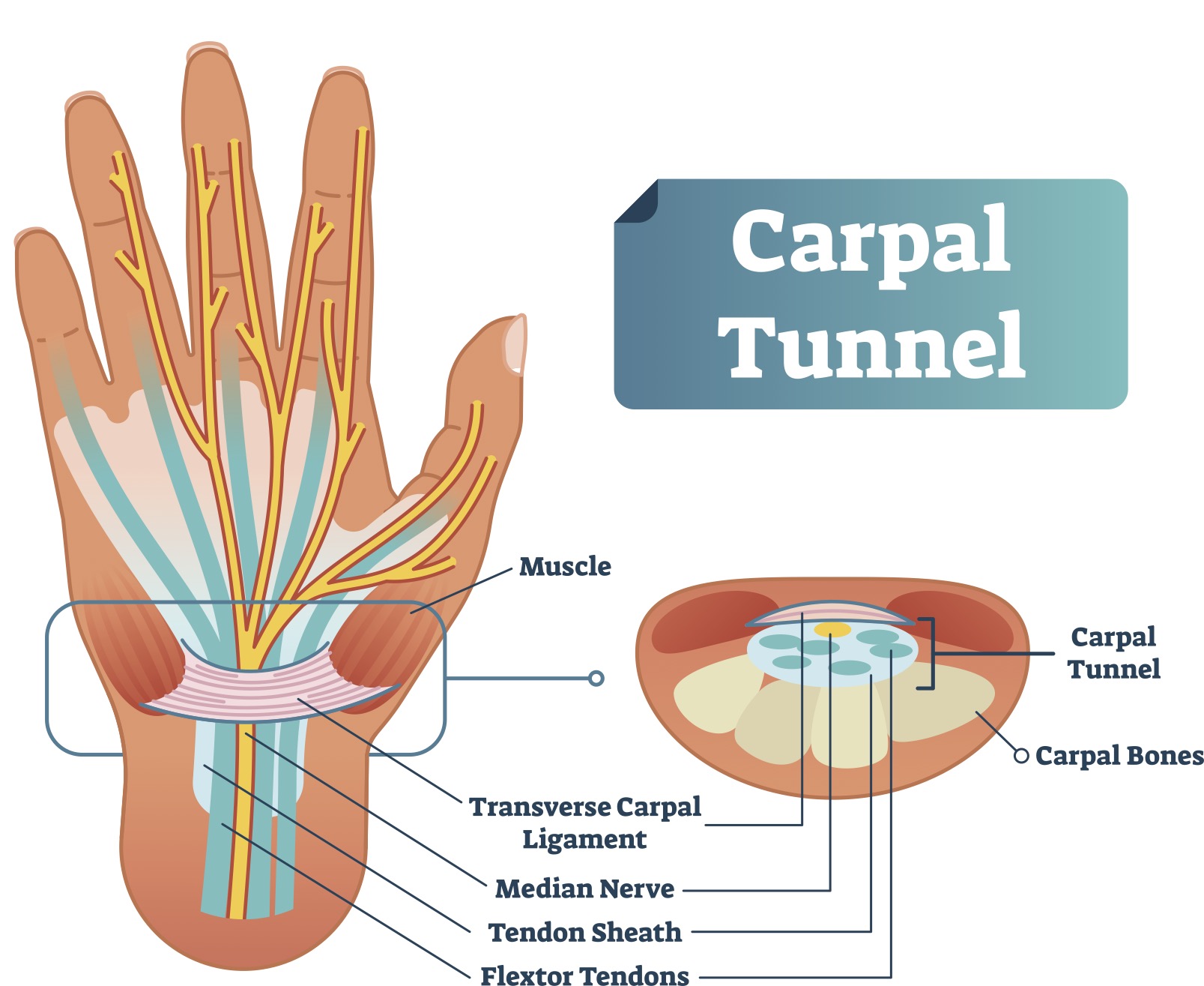 How Long Do Carpal Tunnel Stitches Last? Healing Tips