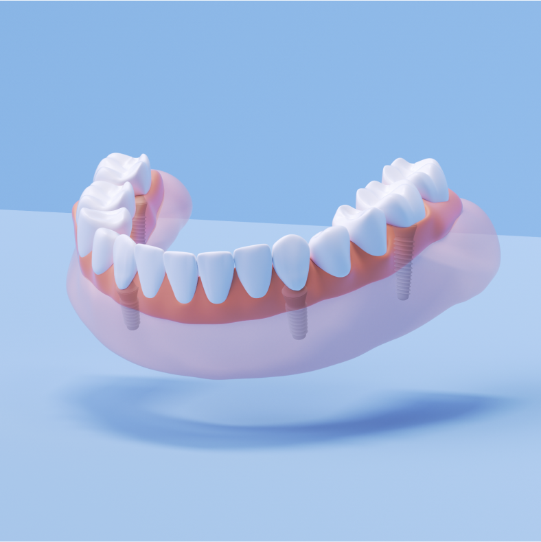 How Much Do Dental Implants Cost At Aspen Dental Cumming Ga?