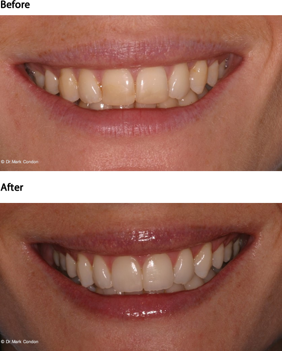 How Much For Teeth Veneers