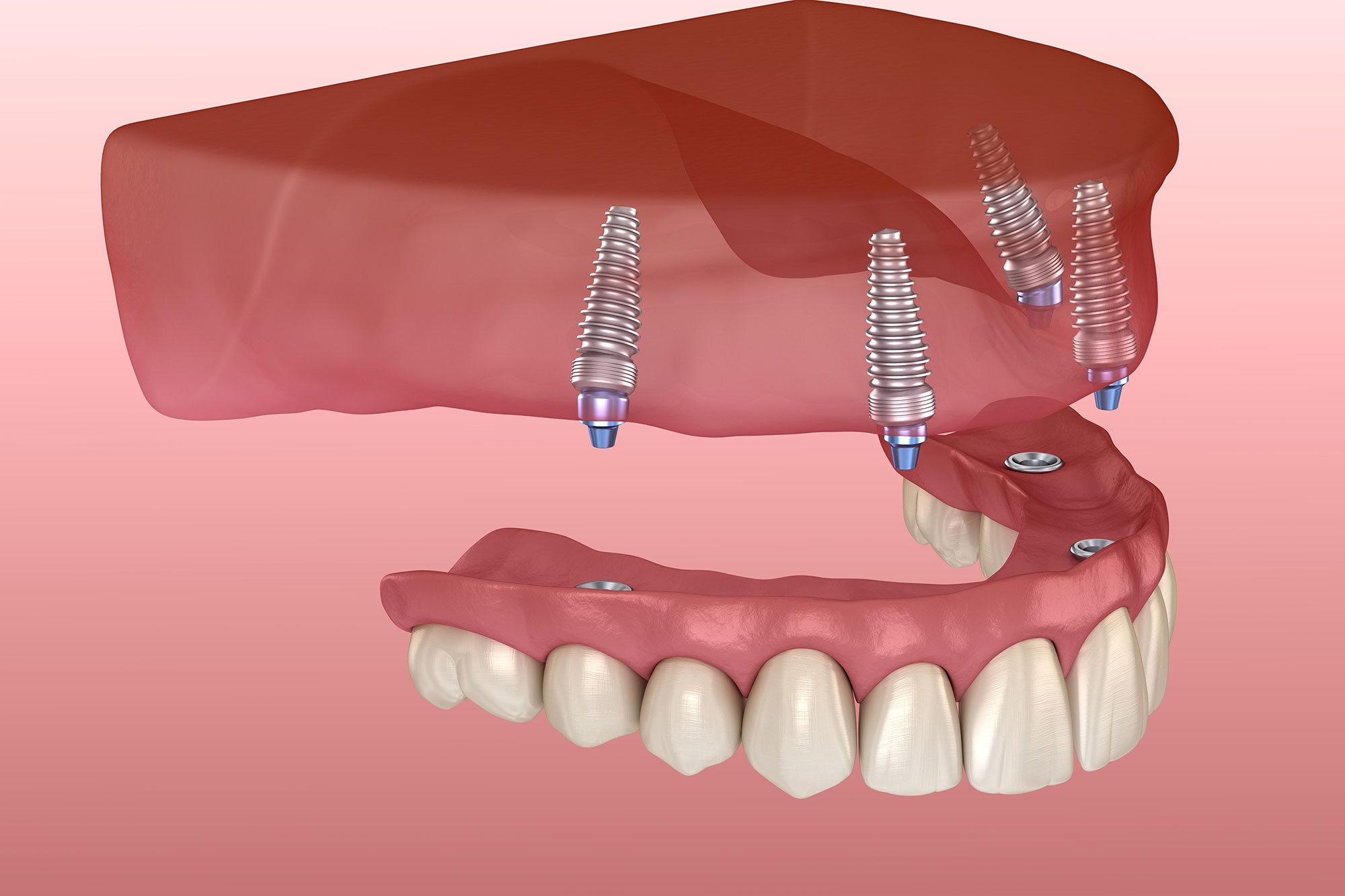 How Much Is Implant Dentures How Much Is Implant Dentures