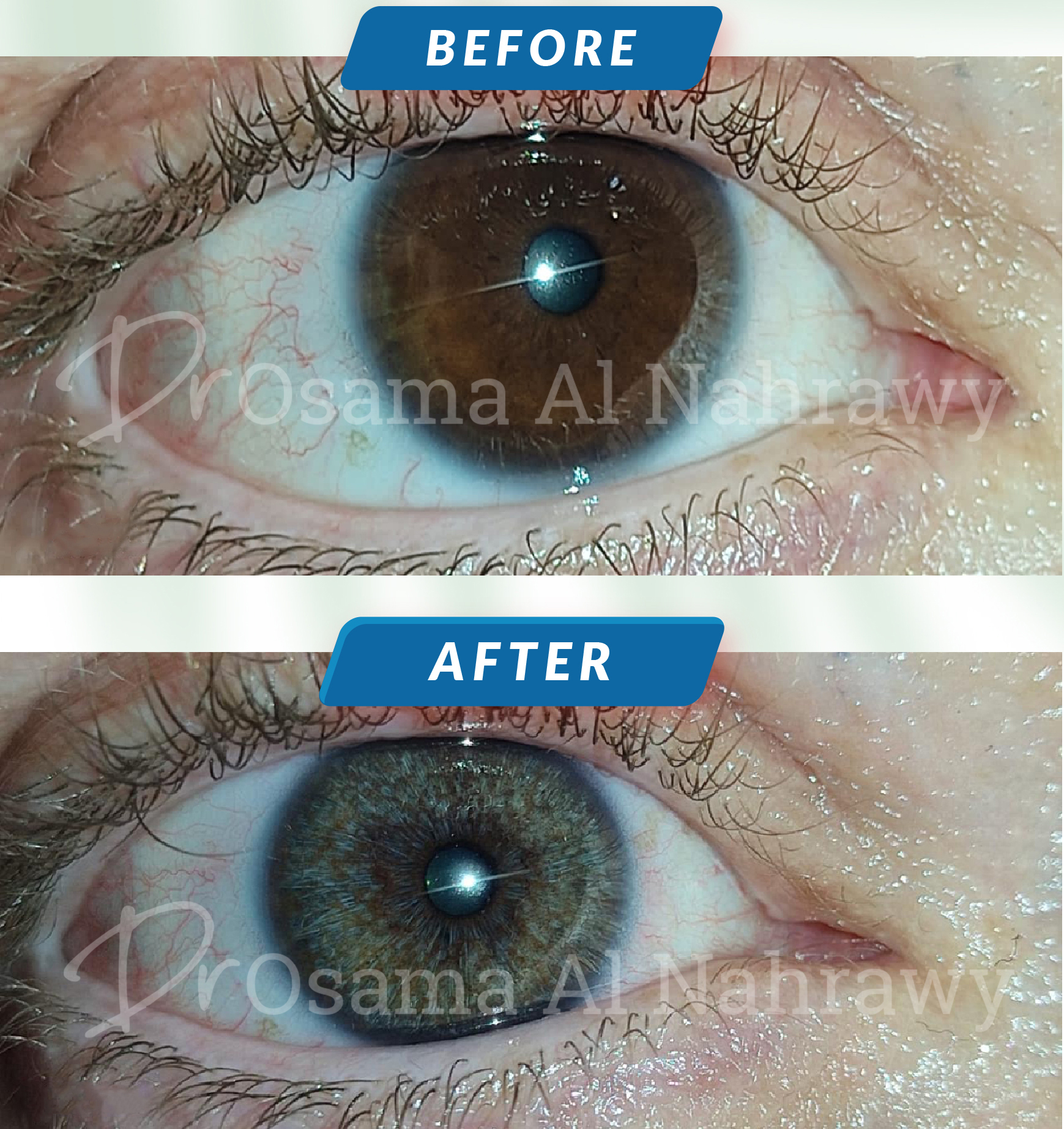 How Much Is Laser Eye Depigmentation? Get Quote