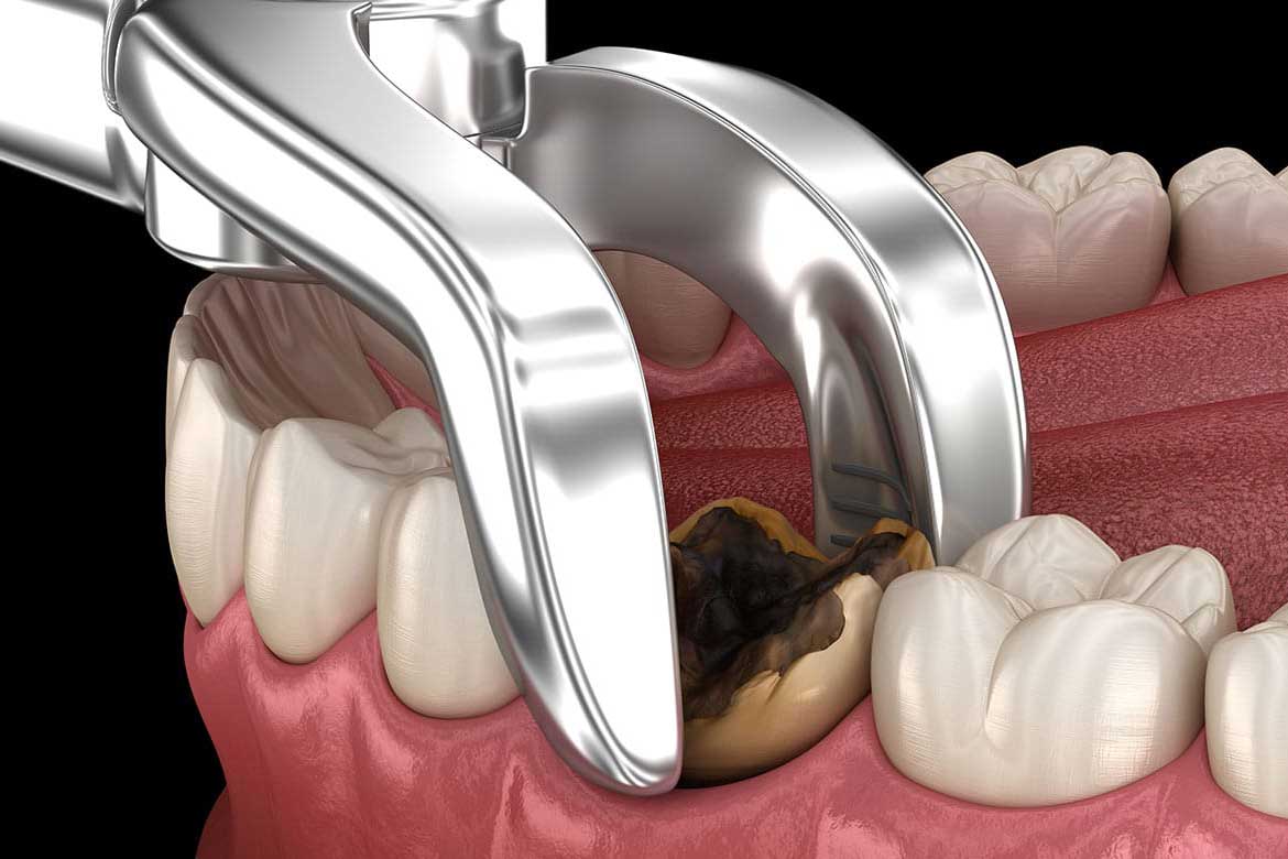 How Much Tooth Extraction Cost? Save Money Today