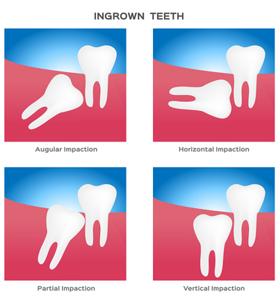 How Safe Is Anesthesia For Wisdom Tooth Removal?